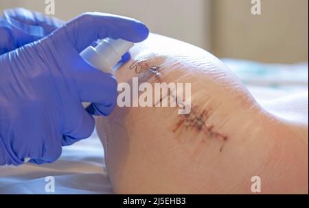 Postoperative dressing, the hands of a doctor in blue gloves, a nurse or a doctor who treats the patient's wound after surgery and disinfects with Stock Photo