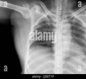 Dislocated right shoulder, X-ray Stock Photo