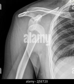 Dislocated right shoulder, X-ray Stock Photo