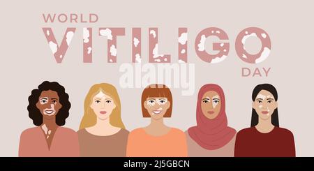 World vitiligo day June 25 banner. Female faces with different ethnics, skin colors, hairstyles with vitiligo skin disease. Body positive concept. Fla Stock Vector
