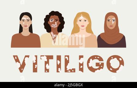 Female faces with vitiligo skin disease banner. World vitiligo day. Portraits with different ethnics, skin colors, hairstyles with vitiligo. Body posi Stock Vector