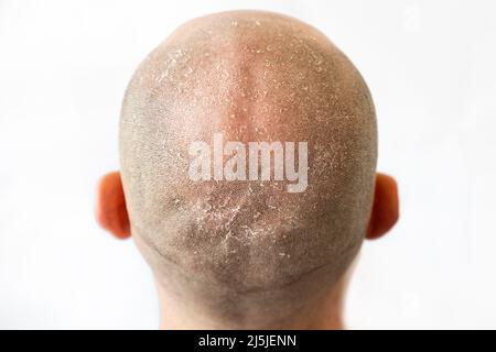 Male bald flaky head with dandruff close-up, back view. White background. The concept of psoriasis and skin problems. Stock Photo