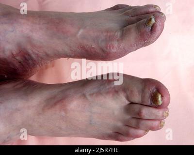 Toenail Fungal Infection, Onychomycosis, Stock Photo of Yellow Nails Thick Toenails, Infected, Brittle Nails, Fungus, Caucasian Feet Stock Photo