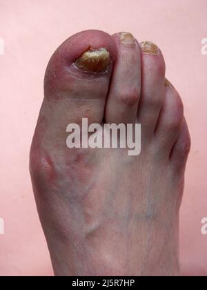 Toenail Fungal Infection, Onychomycosis, Stock Photo of Yellow Nails Thick Toenails, Infected, Brittle Nails, Fungus, Caucasian Feet Stock Photo