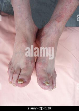 Toenail Fungal Infection, Onychomycosis, Stock Photo of Yellow Nails Thick Toenails, Infected, Brittle Nails, Fungus, Caucasian Feet Stock Photo