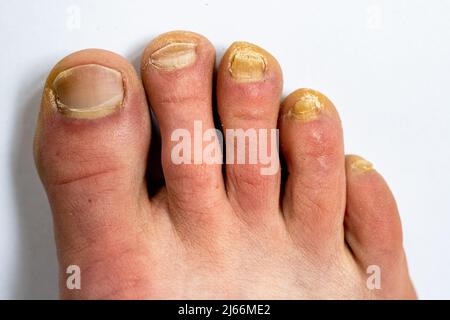 Adult man foot with the nail fungal infection. Stock Photo