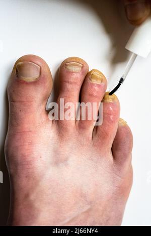 All About Feet - Fungal nail infections are common. They're not serious but  they can take a long time to treat. They usually affect your toenails, but  you can get them on