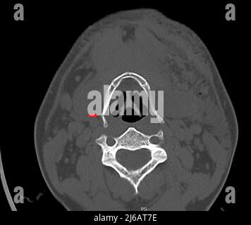 Fractured hyoid bone, CT scan Stock Photo - Alamy