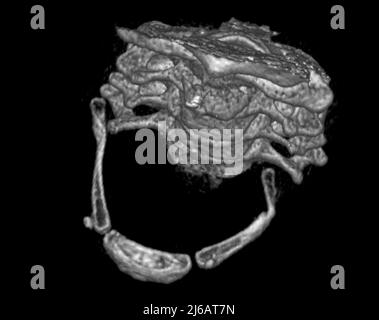 Fractured hyoid bone, 3D CT scan Stock Photo