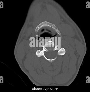 Fractured hyoid bone, CT scan Stock Photo - Alamy