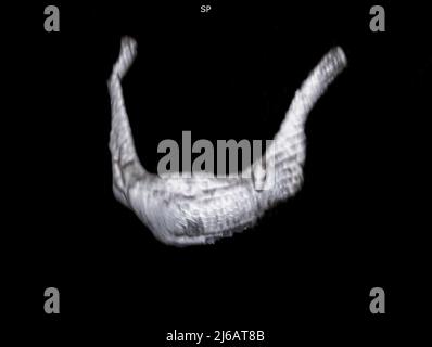 Fractured hyoid bone, 3D CT scan Stock Photo