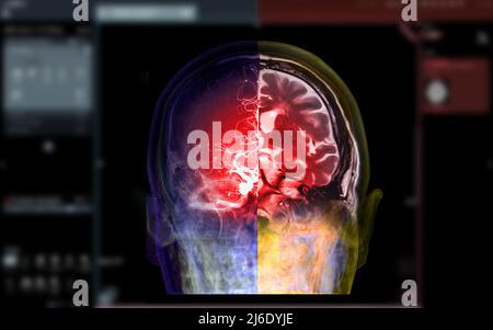 CTA brain and mri brain fusion image . medical technology concept. Stock Photo
