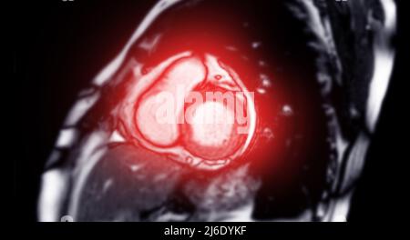 MRI heart or Cardiac MRI ( magnetic resonance imaging ) of heart short axis for diagnosis heart disease. Stock Photo