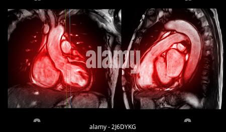 MRI heart or Cardiac MRI magnetic resonance imaging of heart in ...