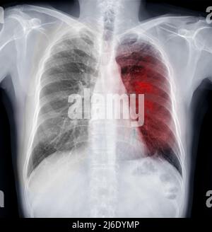 Chest X-ray Of Human Chest or Lung  for detect tuberculosis Stock Photo
