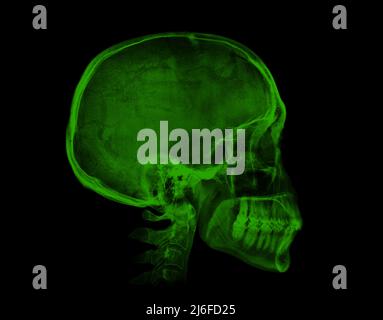 Human skull. Green X-ray image isolated on black background Stock Photo
