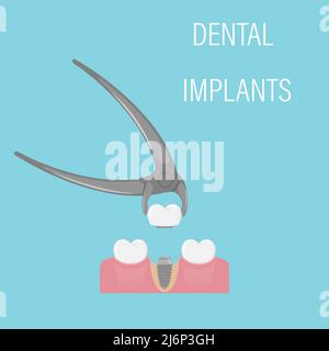 Dental implant installation. Aesthetic dentistry, modern medicine. Implant crown in forceps. A screw in the gum with a bone. Restoration of the dentit Stock Vector