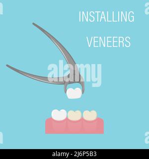 The installation of the veneer. Alternative to bleaching. Cosmetic dental procedure, Aesthetic dentistry, modern medicine. Veneers in forceps. Simple Stock Vector