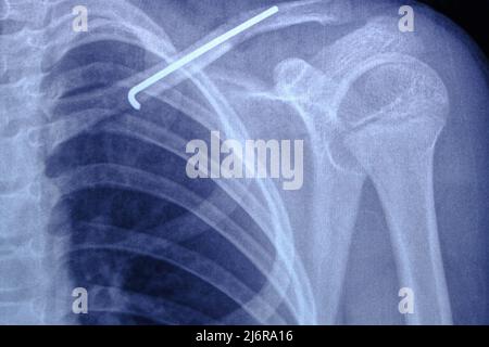 X ray image person with broken collarbone and spoke installed in it after surgery Stock Photo