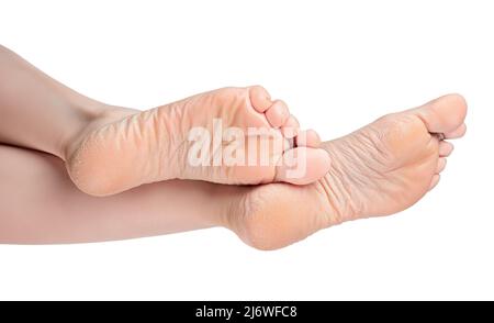 beautiful elegant female legs with dry and rough skin on the soles and heels. Dry Female heels. woman with rough and dry skin on heels of her feet. Dr Stock Photo