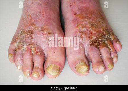 Man's feet affected by Athlete's foot (tinea pedis) disease