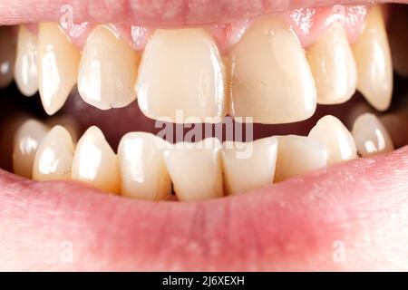 Teeth with tartar and caries, crooked lower foreground incisors, close-up Stock Photo