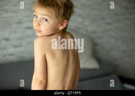 Toddler child, boy with chicken pox, mild rash, first stage of the disease Stock Photo