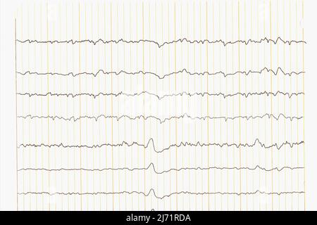 Sinus Heart Rhythm on paper for recording an electrocardiogram. EKG test of patient Stock Photo