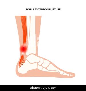 Achilles tendon injury, illustration Stock Photo