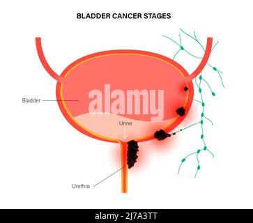 Bladder cancer stages, illustration Stock Photo