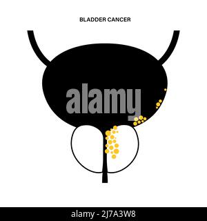 Bladder cancer stages, illustration Stock Photo