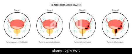 Bladder cancer stages, illustration Stock Photo