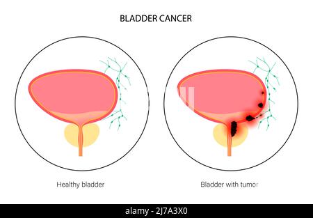 Bladder cancer stages, illustration Stock Photo