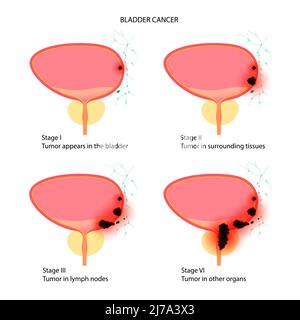 Bladder cancer stages, illustration Stock Photo