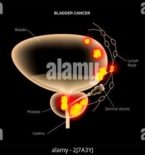 Bladder cancer stages, illustration Stock Photo