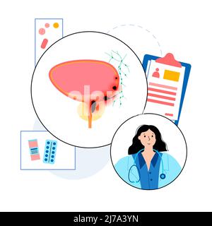 Bladder cancer stages, illustration Stock Photo