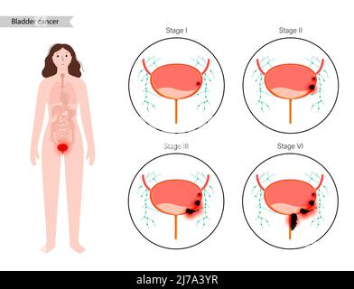 Bladder cancer stages, illustration Stock Photo