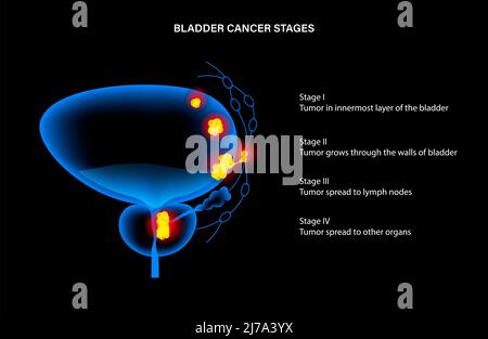 Bladder cancer stages, illustration Stock Photo