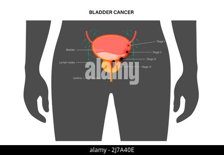 Bladder cancer stages, illustration Stock Photo