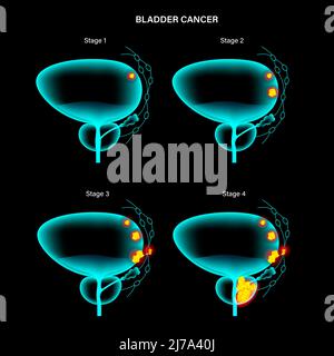 Bladder cancer stages, illustration Stock Photo