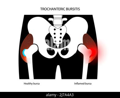 Hip bursitis, conceptual illustration Stock Photo