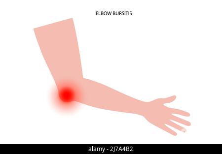 Elbow bursitis, illustration Stock Photo