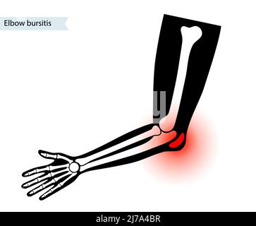 Elbow bursitis, illustration Stock Photo