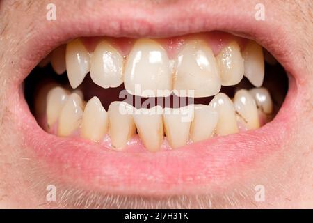 Teeth with tartar and caries, crooked lower foreground incisors, close-up Stock Photo