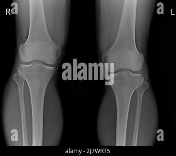 X-ray image of two male kneescalves Stock Photo