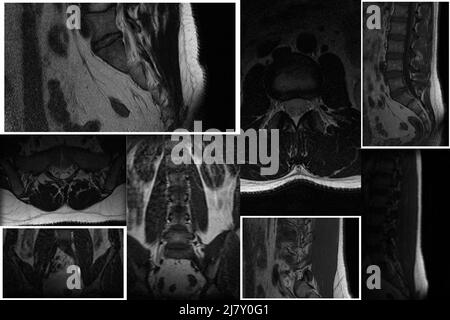 Computed tomography of the spine from different angles of a young man with a dorsal intervertebral hernia, diagnosis and detection of hernial and pain Stock Photo