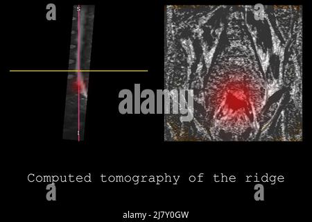 Computed tomography of the spine in a young man with a dorsal intervertebral hernia, diagnosis and detection of hernia and pain effects, banner layout Stock Photo