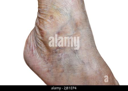 Prominent veins visible through the thin skin of Asian old woman. Stock Photo