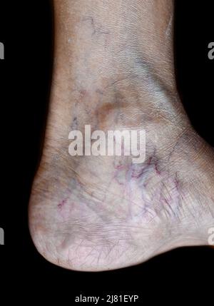 Prominent veins visible through the thin skin of Asian old woman. Stock Photo