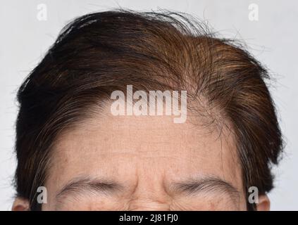 Skin creases or wrinkles at forehead of Southeast Asian, Myanmar or Burmese elder woman. Symptom of aging. Stock Photo